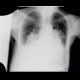 Pulmonary embolism, pulmonary hypertension, cardiomegally, correlation: X-ray - Plain radiograph